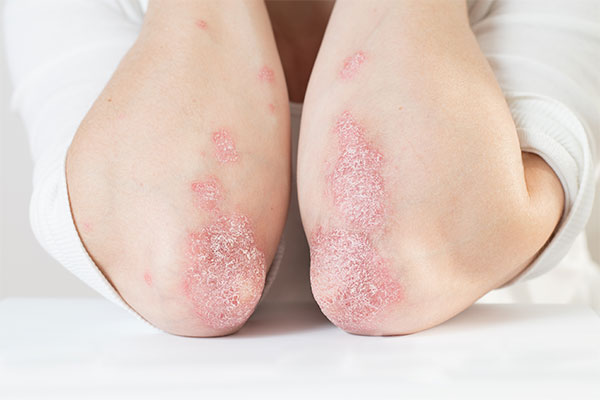 Schuppenflechte (Psoriasis) · MVZ MADERMA GmbH Dr. Mader & Kollegen · Hautarzt Praxis Bottrop ·